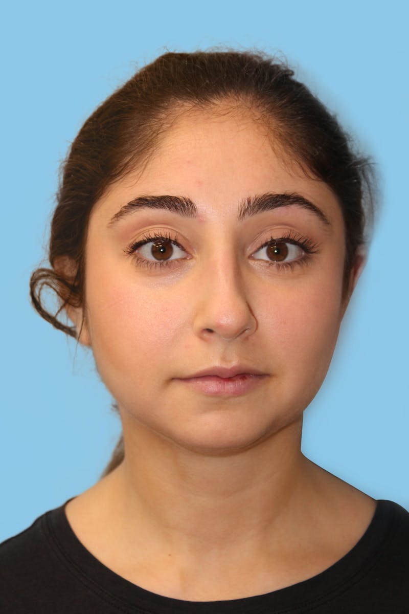 Rhinoplasty Before & After Gallery - Patient 597875 - Image 1