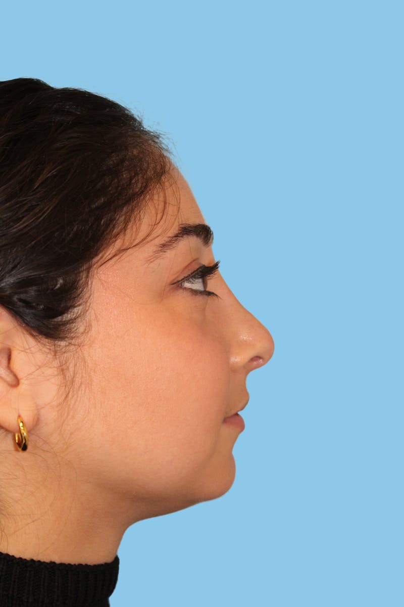Rhinoplasty Before & After Gallery - Patient 597875 - Image 4
