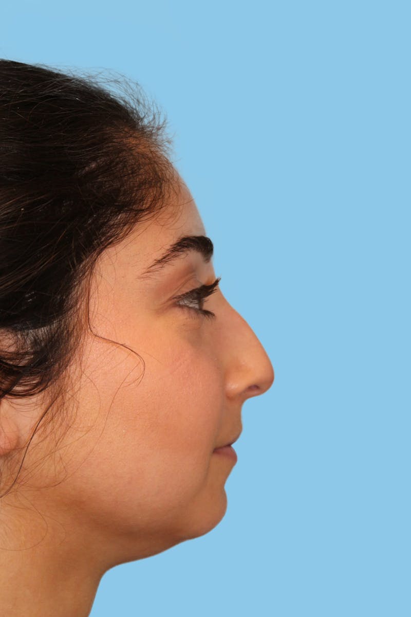 Rhinoplasty Before & After Gallery - Patient 597875 - Image 3