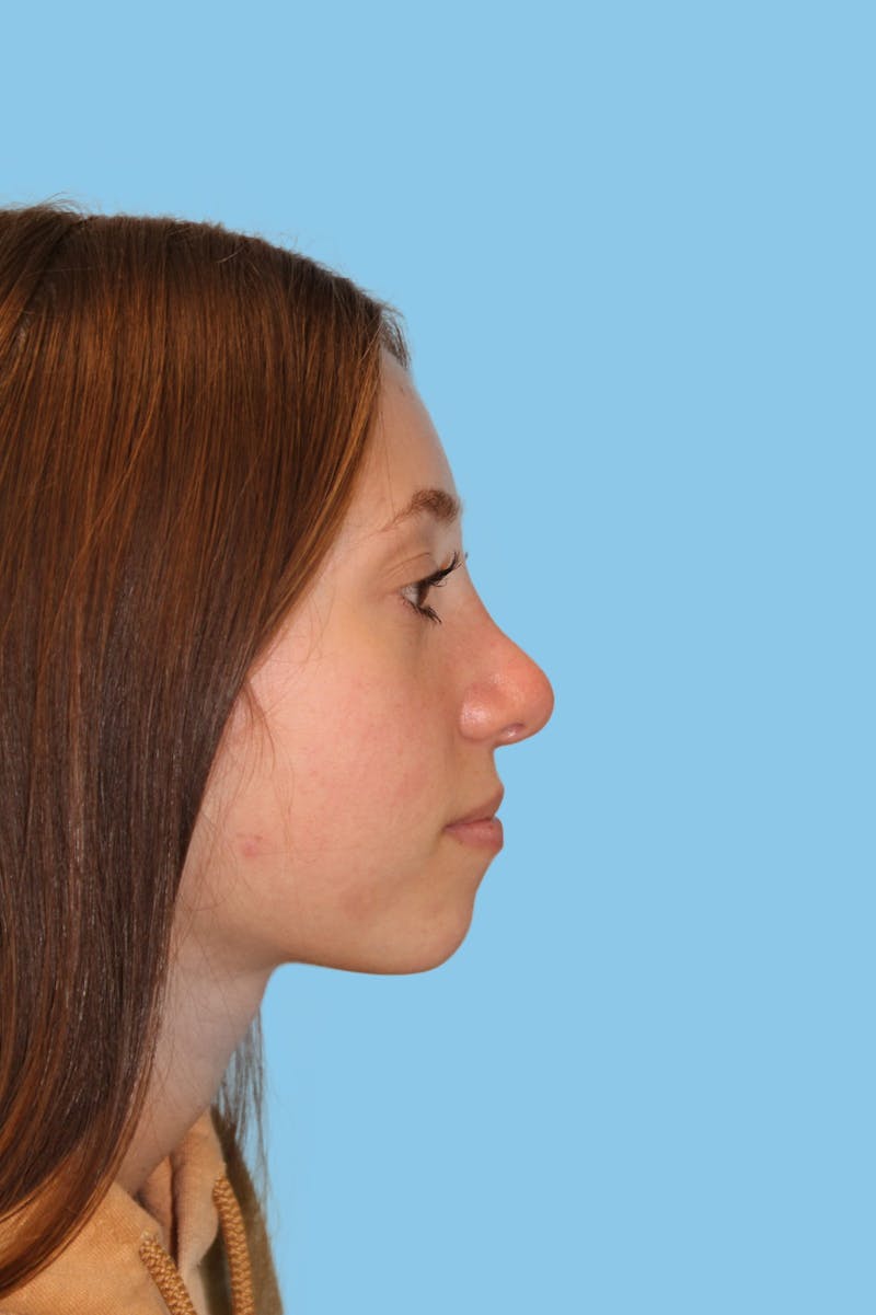 Rhinoplasty Before & After Gallery - Patient 237746 - Image 2