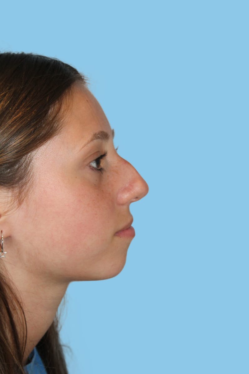 Rhinoplasty Before & After Gallery - Patient 237746 - Image 1