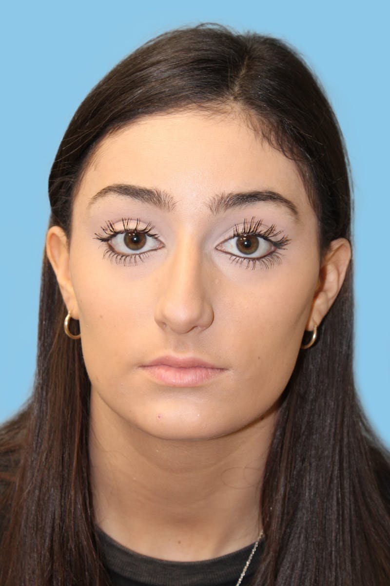 Rhinoplasty Before & After Gallery - Patient 106016 - Image 1