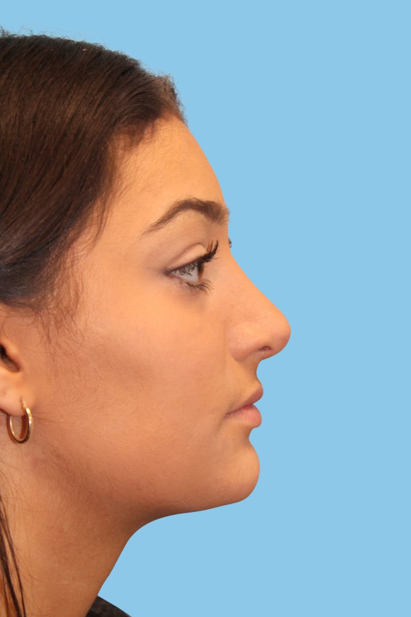 Rhinoplasty Before & After Gallery - Patient 106016 - Image 4