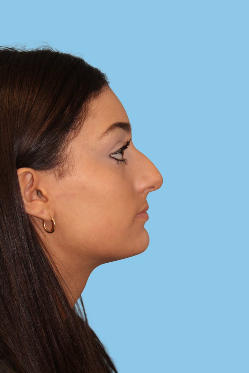 Rhinoplasty Before & After Gallery - Patient 106016 - Image 3