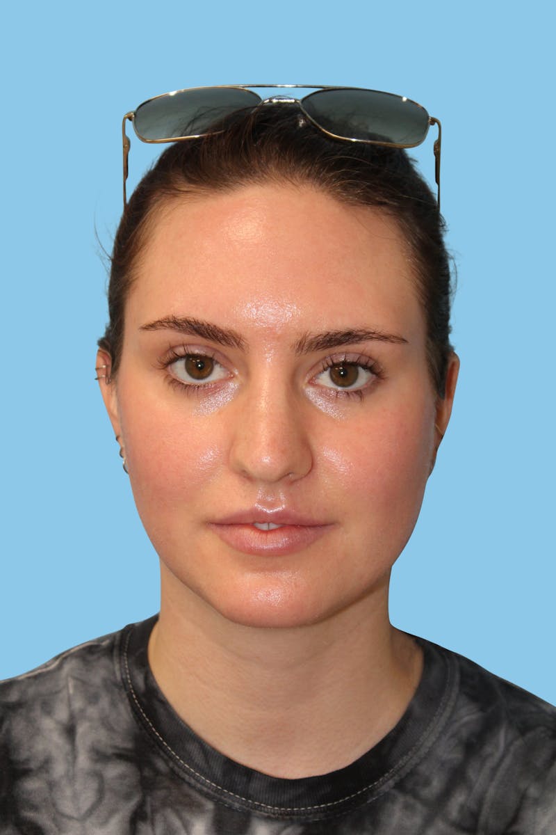 Rhinoplasty Before & After Gallery - Patient 385071 - Image 1