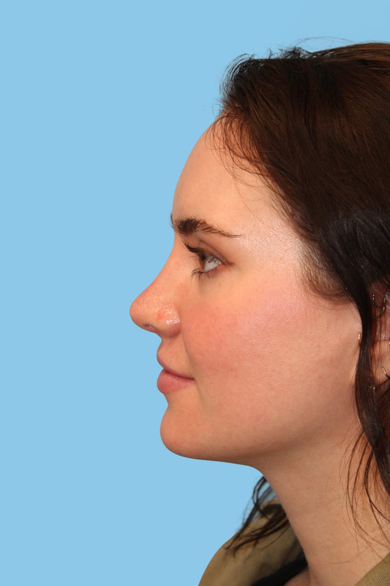Rhinoplasty Before & After Gallery - Patient 385071 - Image 4