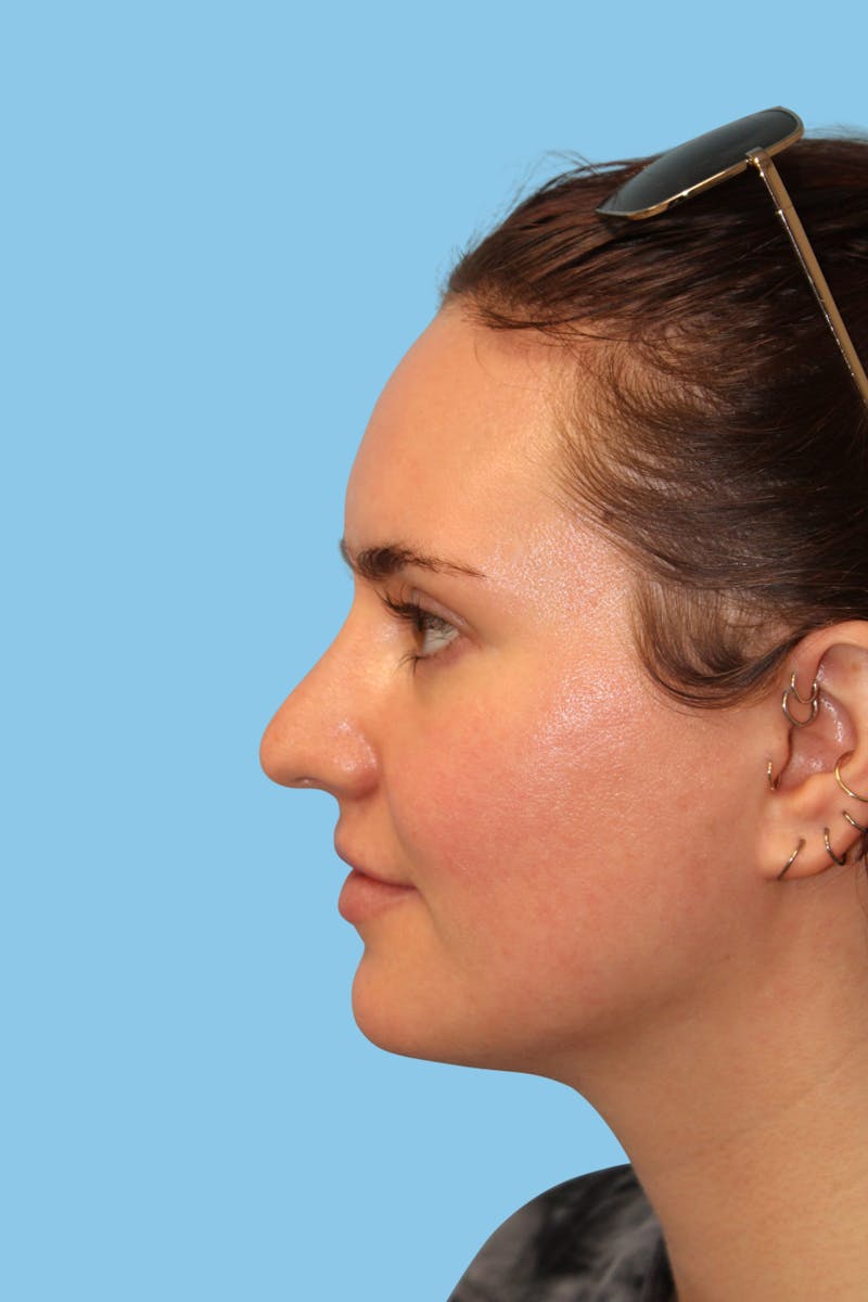 Rhinoplasty Before & After Gallery - Patient 385071 - Image 3