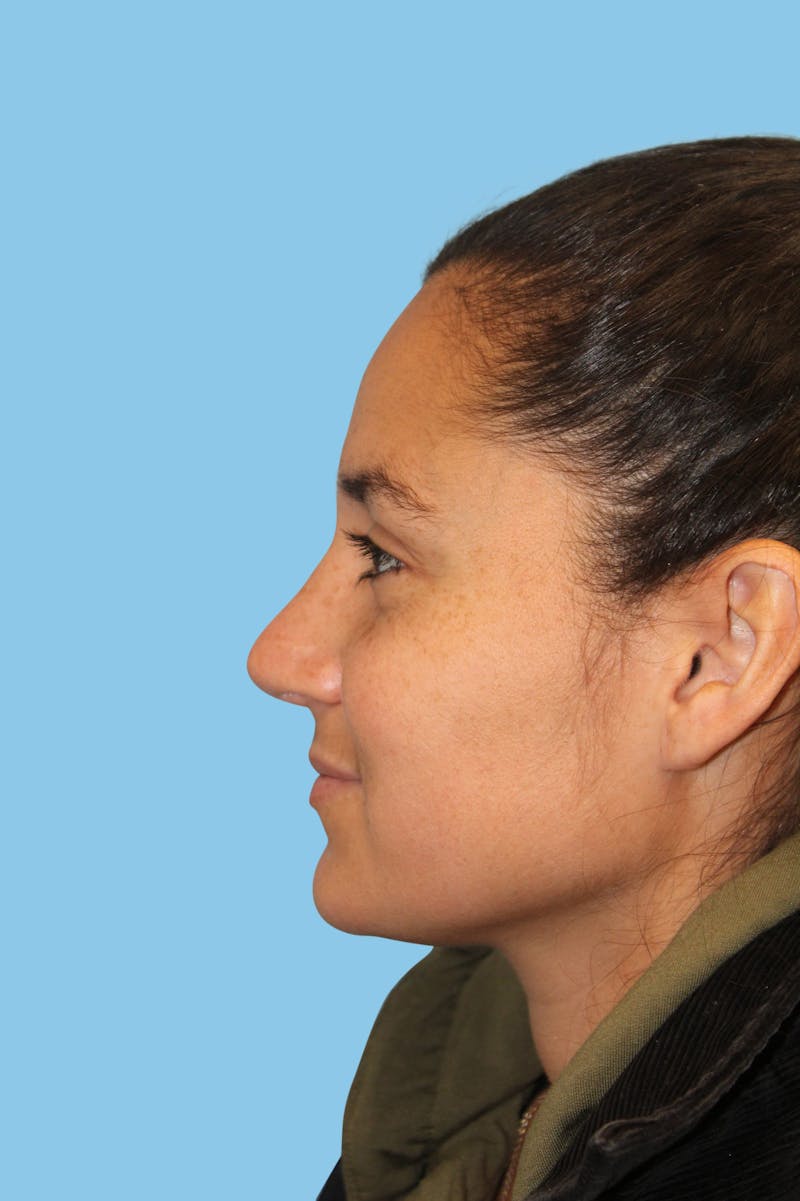 Rhinoplasty Before & After Gallery - Patient 158302 - Image 4