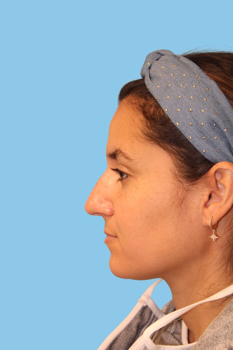 Rhinoplasty Before & After Gallery - Patient 158302 - Image 3