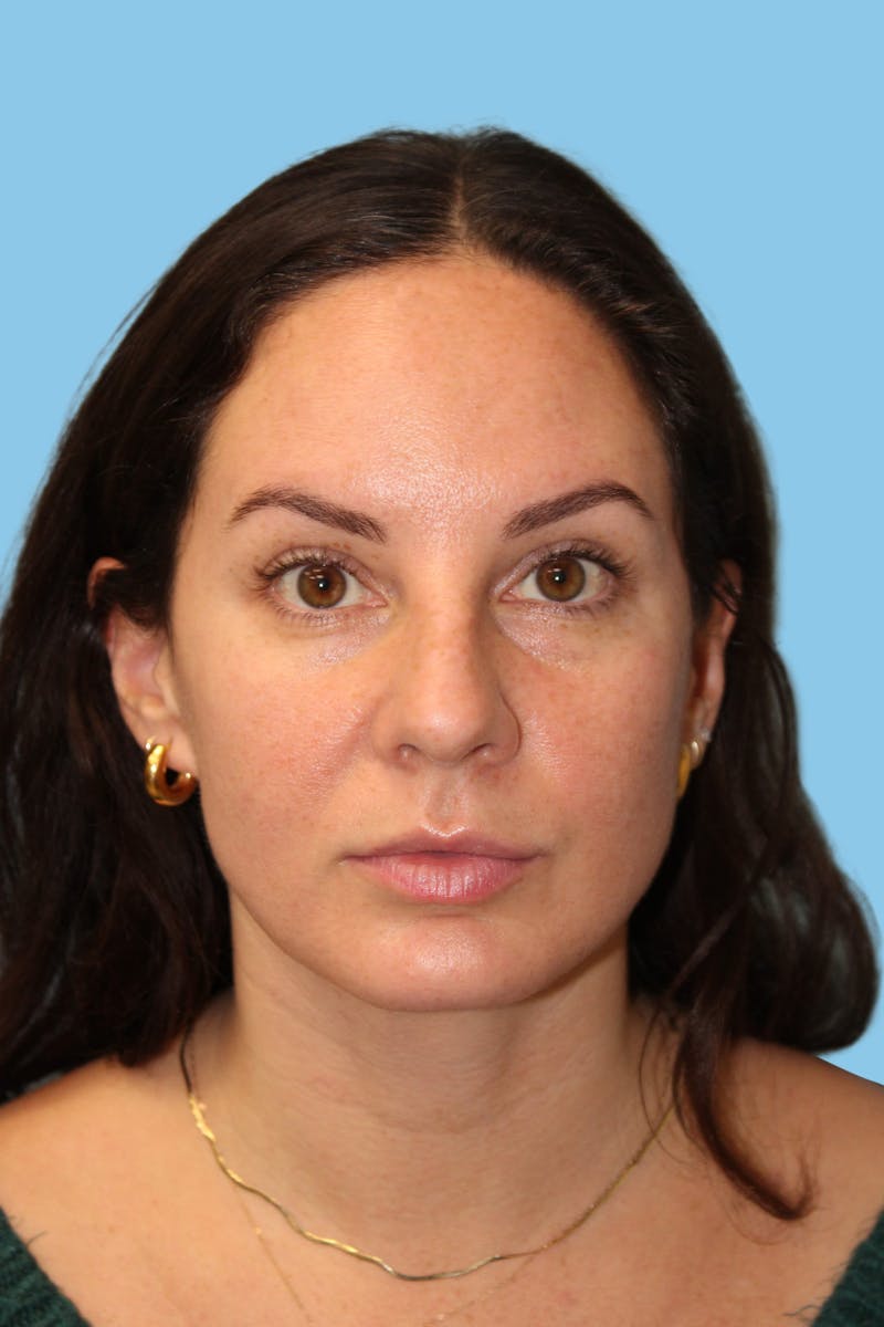 Rhinoplasty Before & After Gallery - Patient 132158 - Image 1