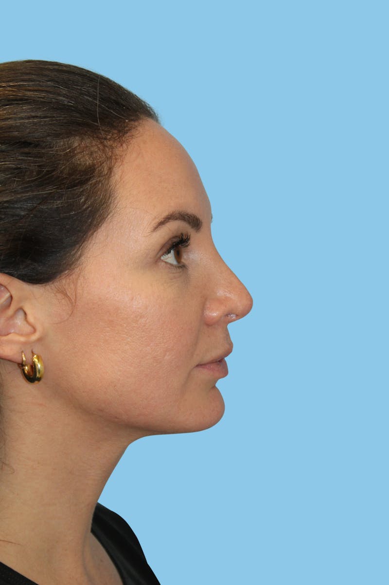 Rhinoplasty Before & After Gallery - Patient 132158 - Image 4