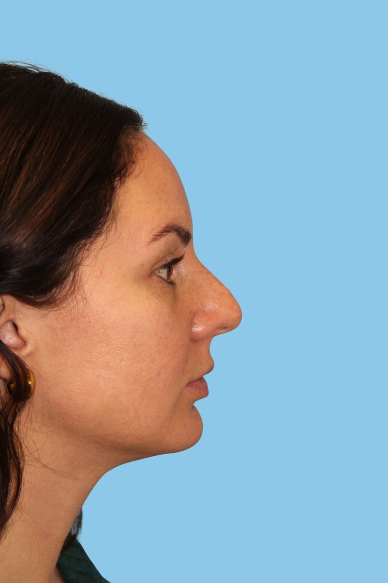 Rhinoplasty Before & After Gallery - Patient 132158 - Image 3