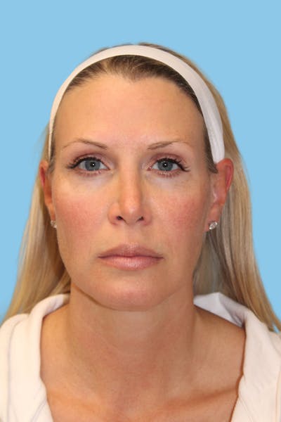 Revision Rhinoplasty Before & After Gallery - Patient 404050 - Image 2