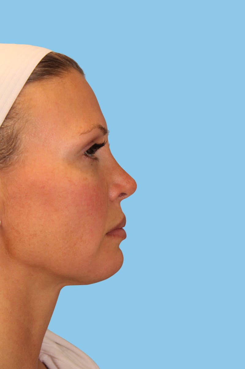 Revision Rhinoplasty Before & After Gallery - Patient 404050 - Image 4