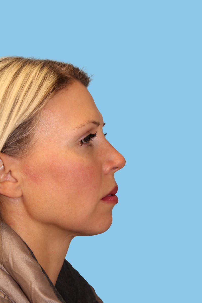 Revision Rhinoplasty Before & After Gallery - Patient 404050 - Image 3