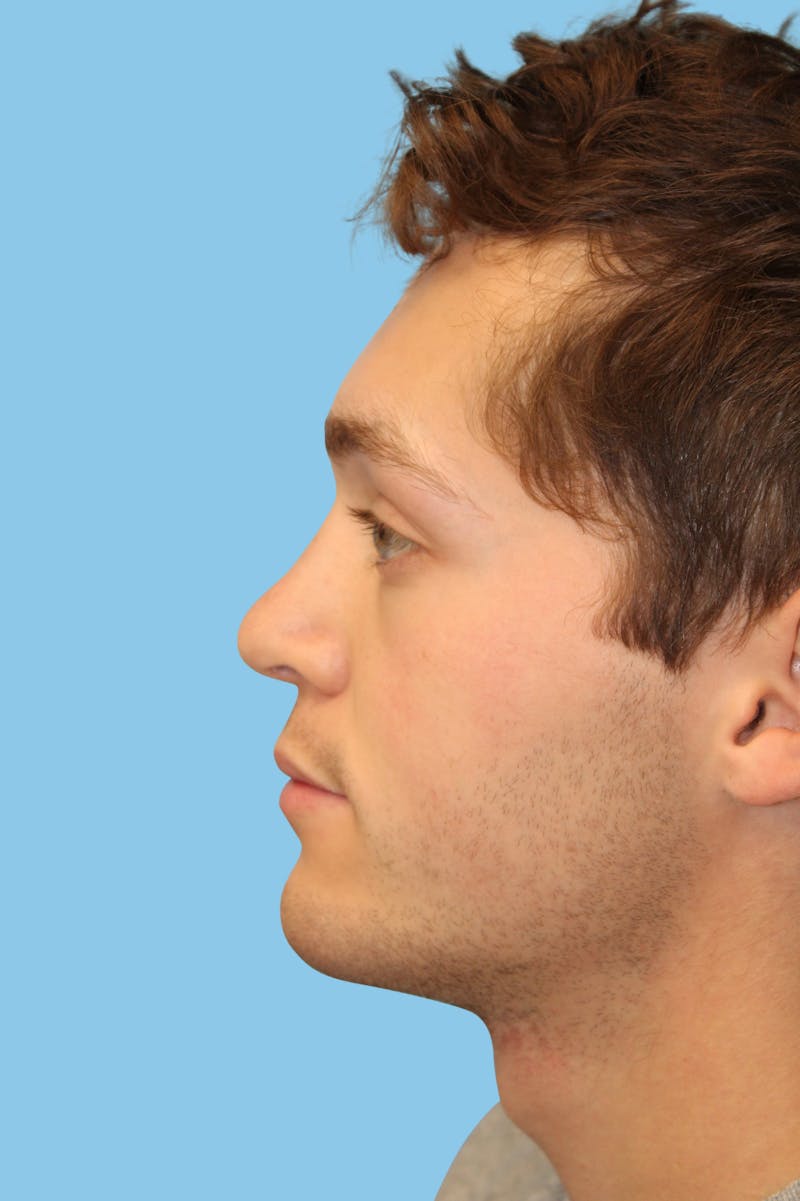 Rhinoplasty Before & After Gallery - Patient 277808 - Image 4
