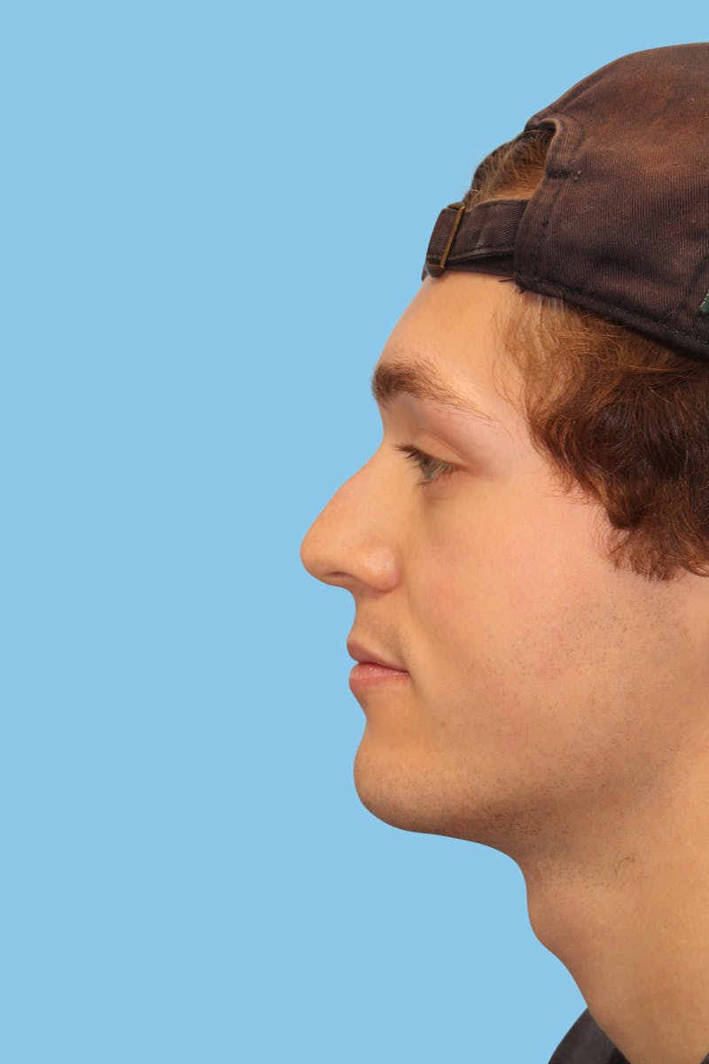 Rhinoplasty Before & After Gallery - Patient 277808 - Image 3