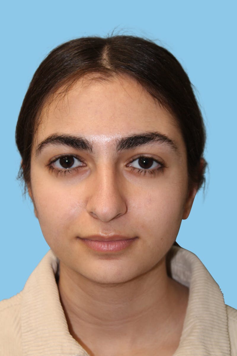 Rhinoplasty Before & After Gallery - Patient 131539 - Image 1