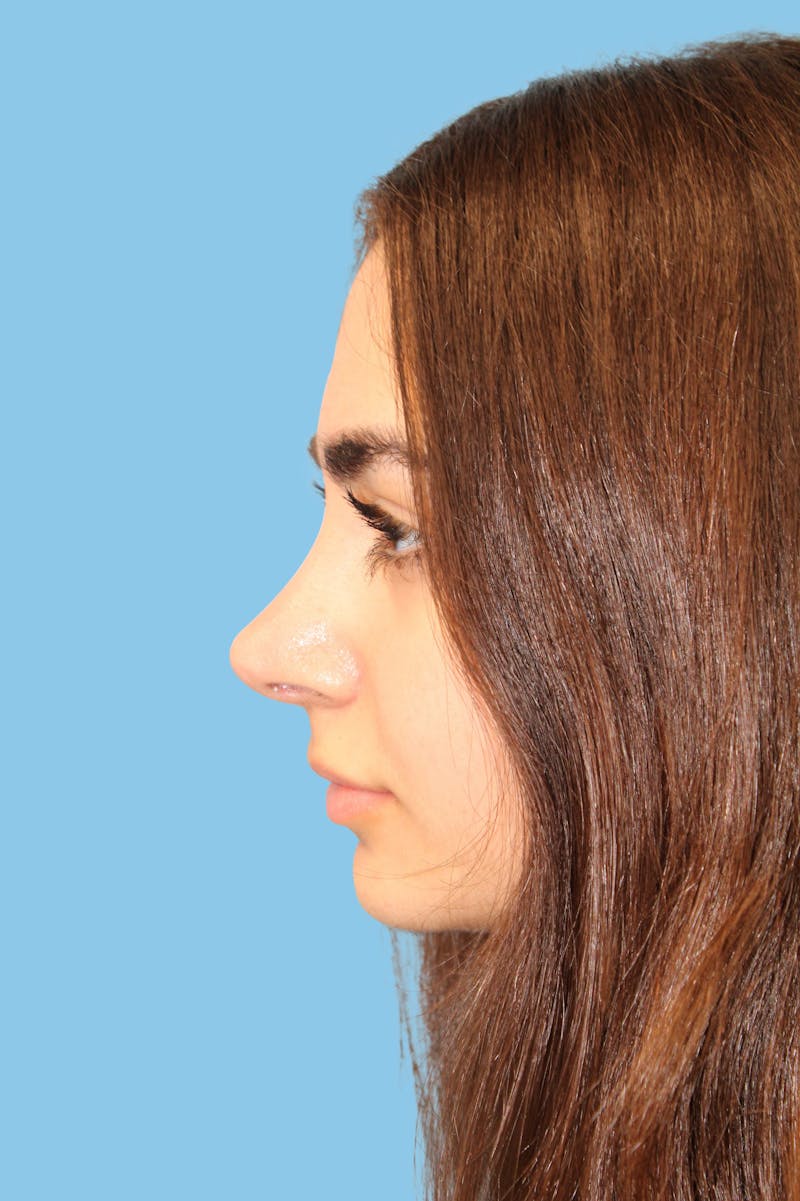 Rhinoplasty Before & After Gallery - Patient 131539 - Image 4