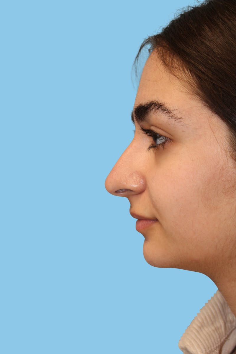 Rhinoplasty Before & After Gallery - Patient 131539 - Image 3