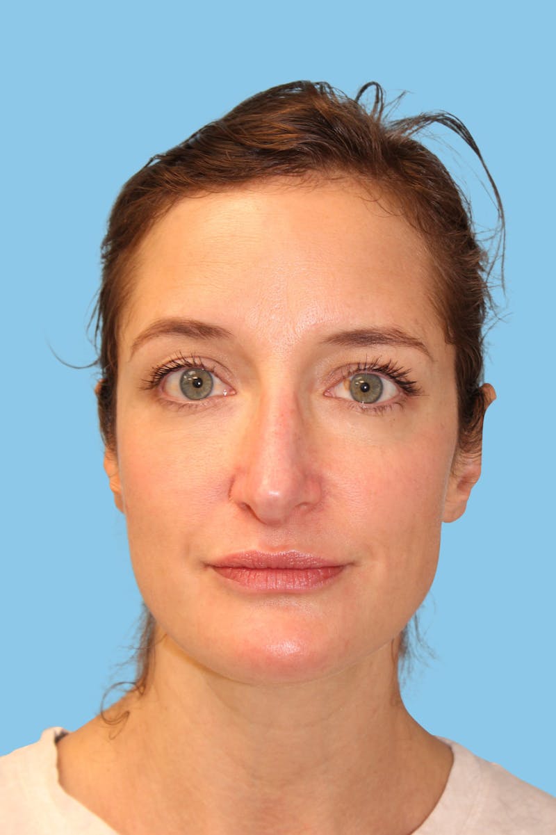 Rhinoplasty Before & After Gallery - Patient 111796 - Image 2