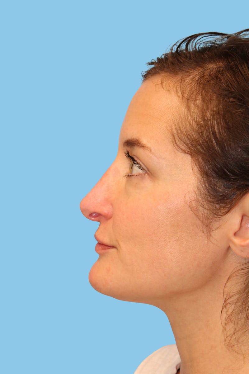 Rhinoplasty Before & After Gallery - Patient 111796 - Image 4