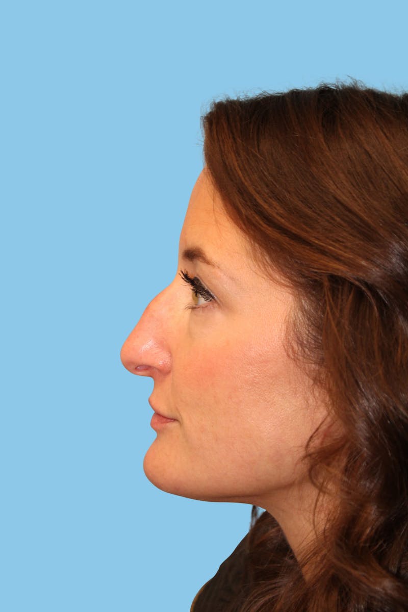 Rhinoplasty Before & After Gallery - Patient 111796 - Image 3