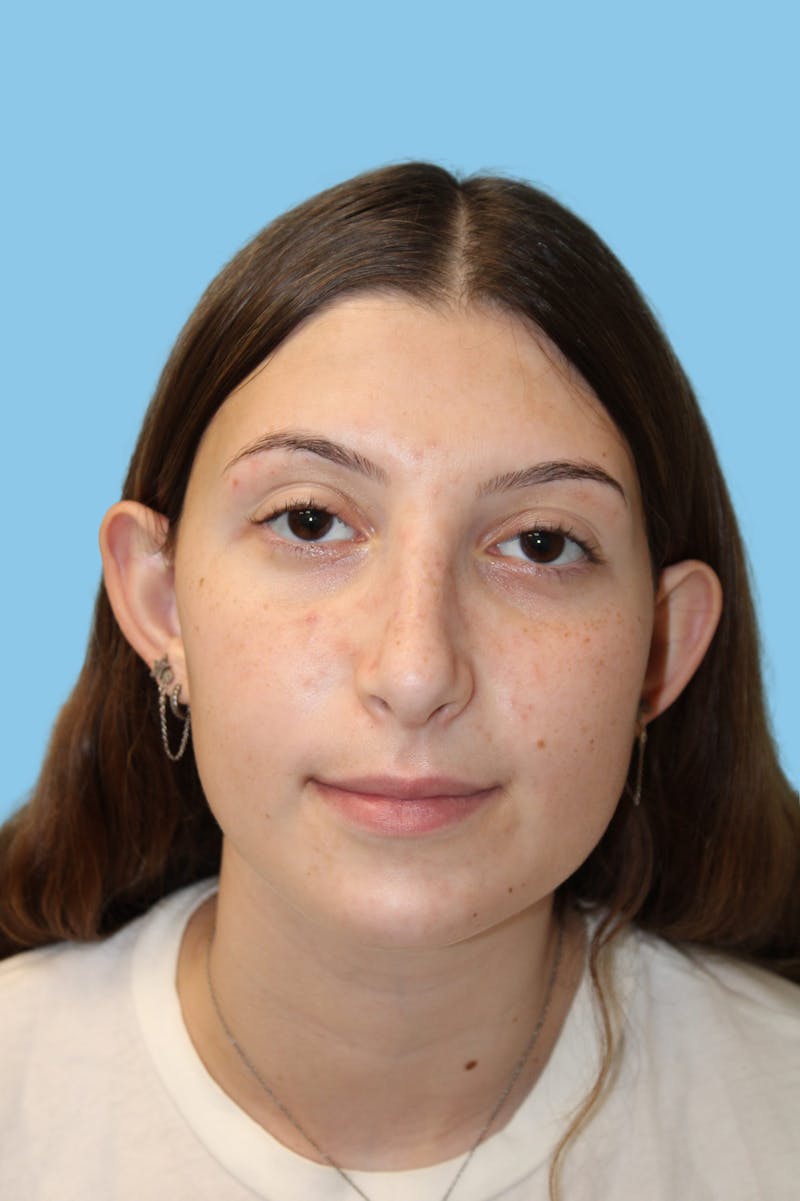 Rhinoplasty Before & After Gallery - Patient 968030 - Image 2
