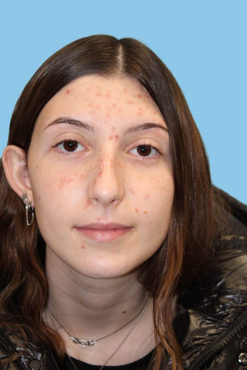 Rhinoplasty Before & After Gallery - Patient 968030 - Image 1