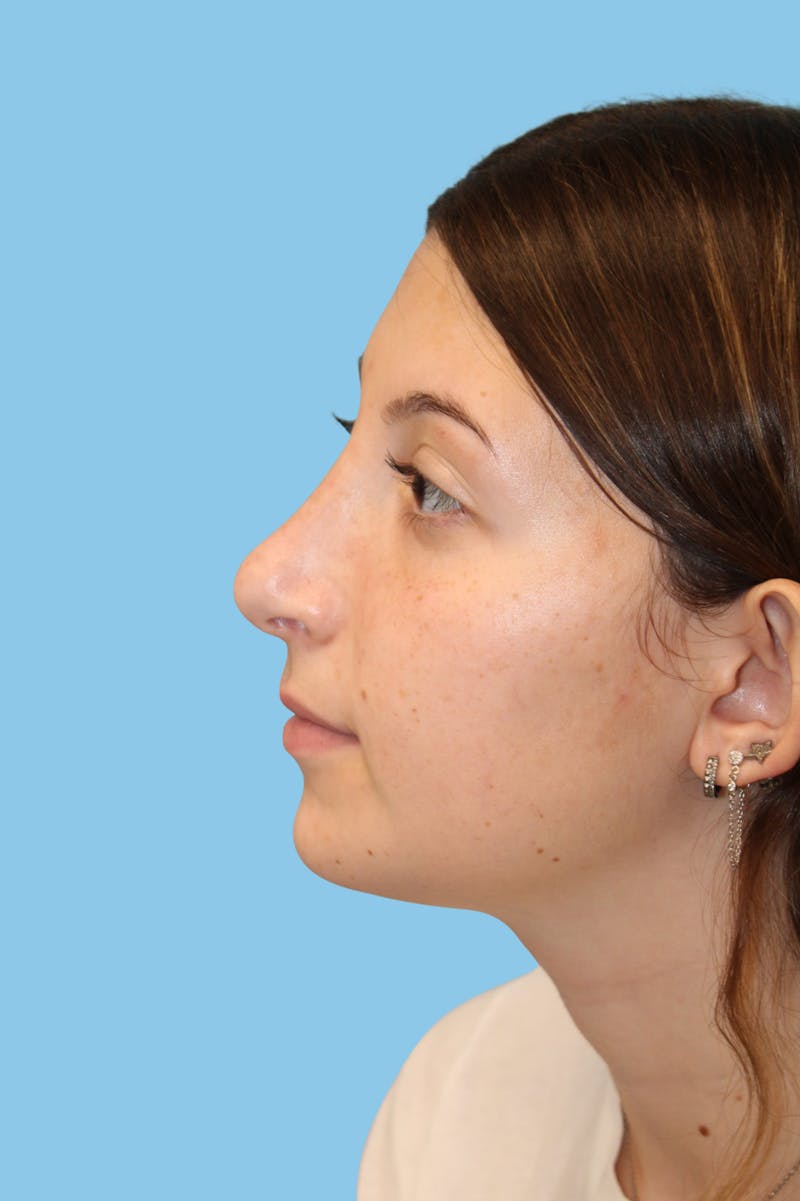 Rhinoplasty Before & After Gallery - Patient 968030 - Image 4