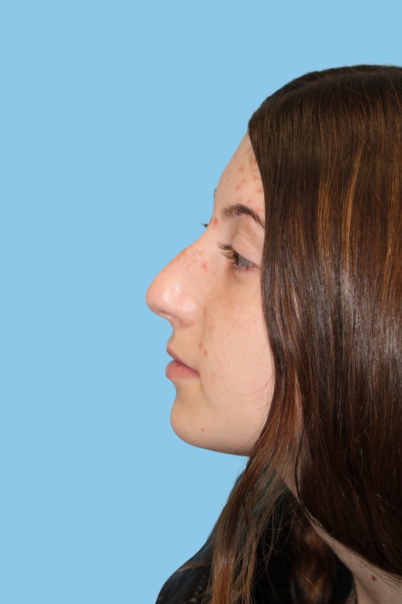 Rhinoplasty Before & After Gallery - Patient 968030 - Image 3