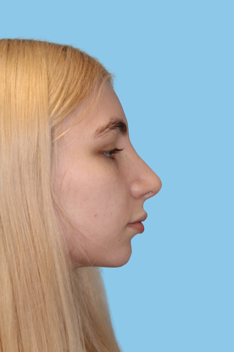 Rhinoplasty Before & After Gallery - Patient 591143 - Image 3