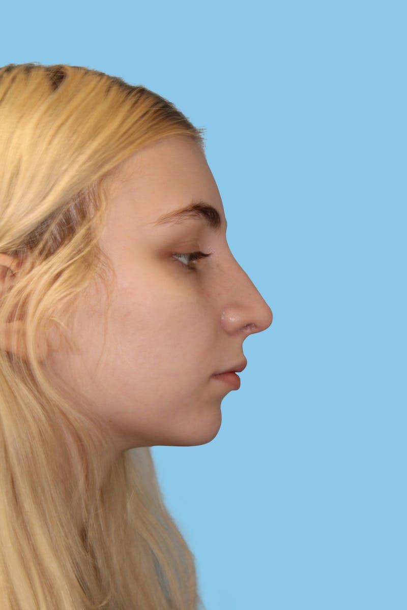 Rhinoplasty Before & After Gallery - Patient 591143 - Image 4