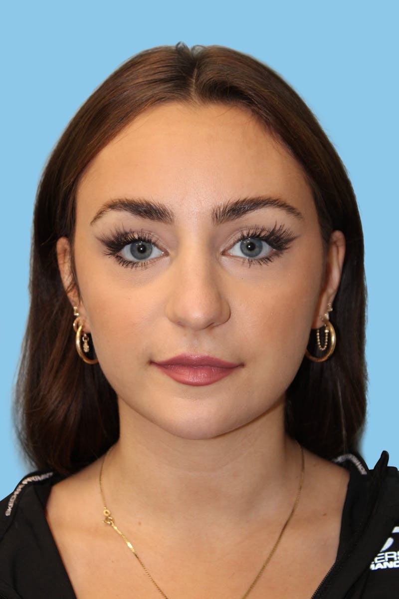 Rhinoplasty Before & After Gallery - Patient 321338 - Image 1