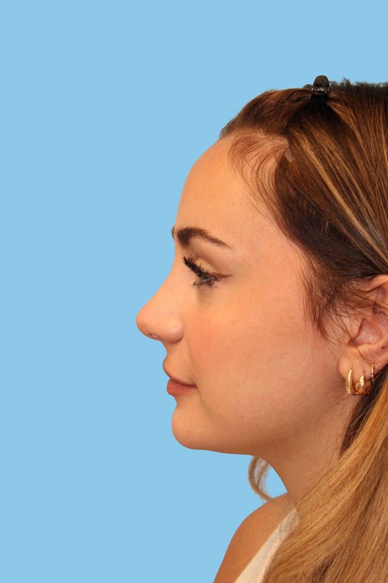 Rhinoplasty Before & After Gallery - Patient 321338 - Image 4