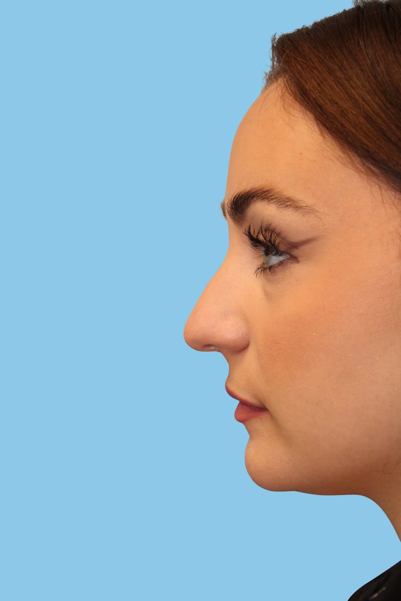 Rhinoplasty Before & After Gallery - Patient 321338 - Image 3
