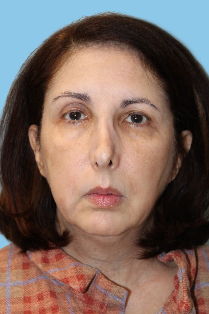 Rhinoplasty Before & After Gallery - Patient 381958 - Image 1