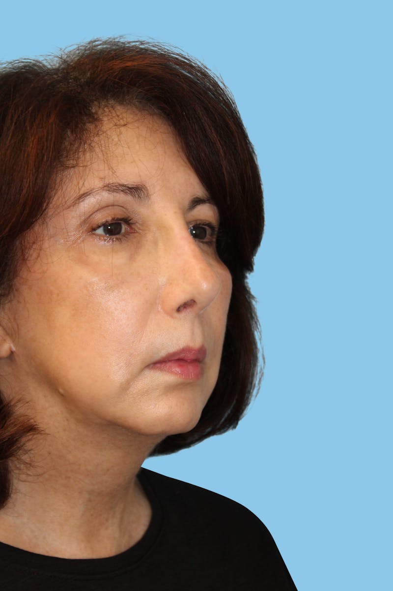 Revision Rhinoplasty Before & After Gallery - Patient 193599 - Image 4