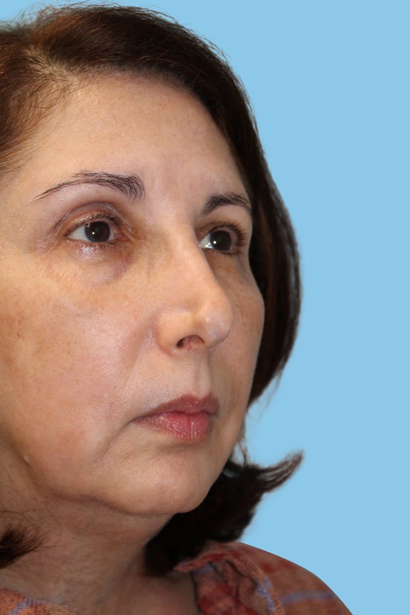 Rhinoplasty Before & After Gallery - Patient 381958 - Image 3