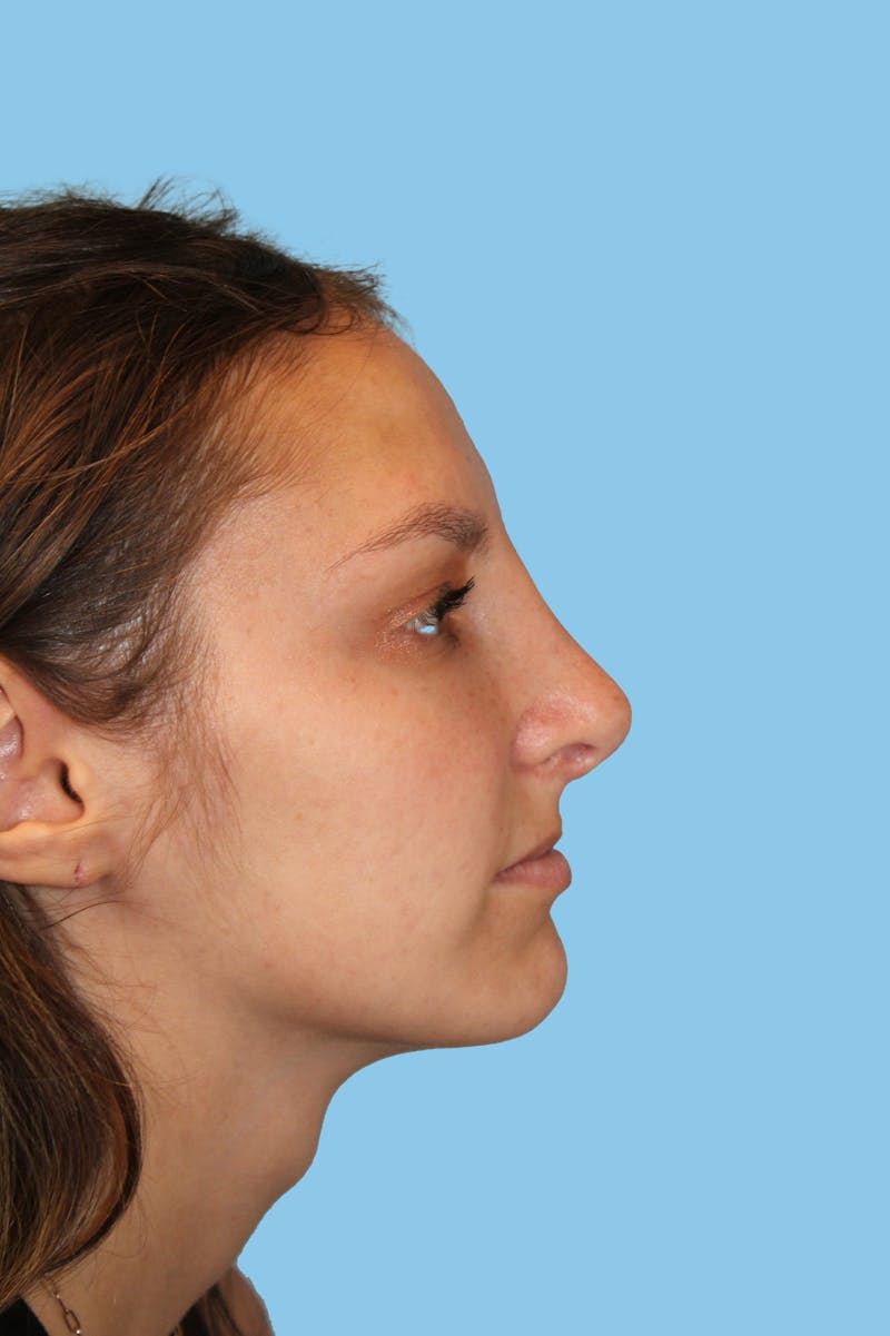 Rhinoplasty Before & After Gallery - Patient 306141 - Image 2