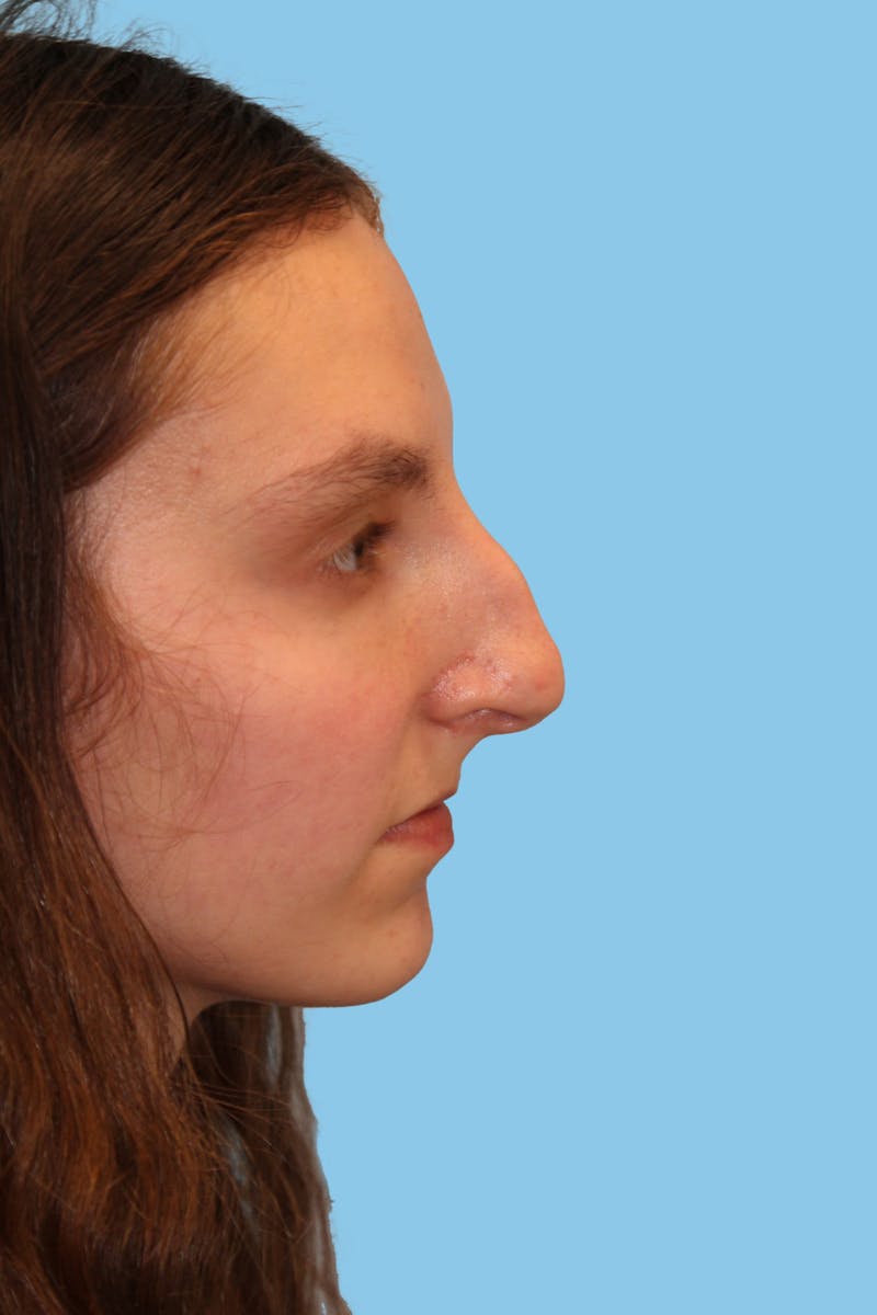 Rhinoplasty Before & After Gallery - Patient 306141 - Image 1