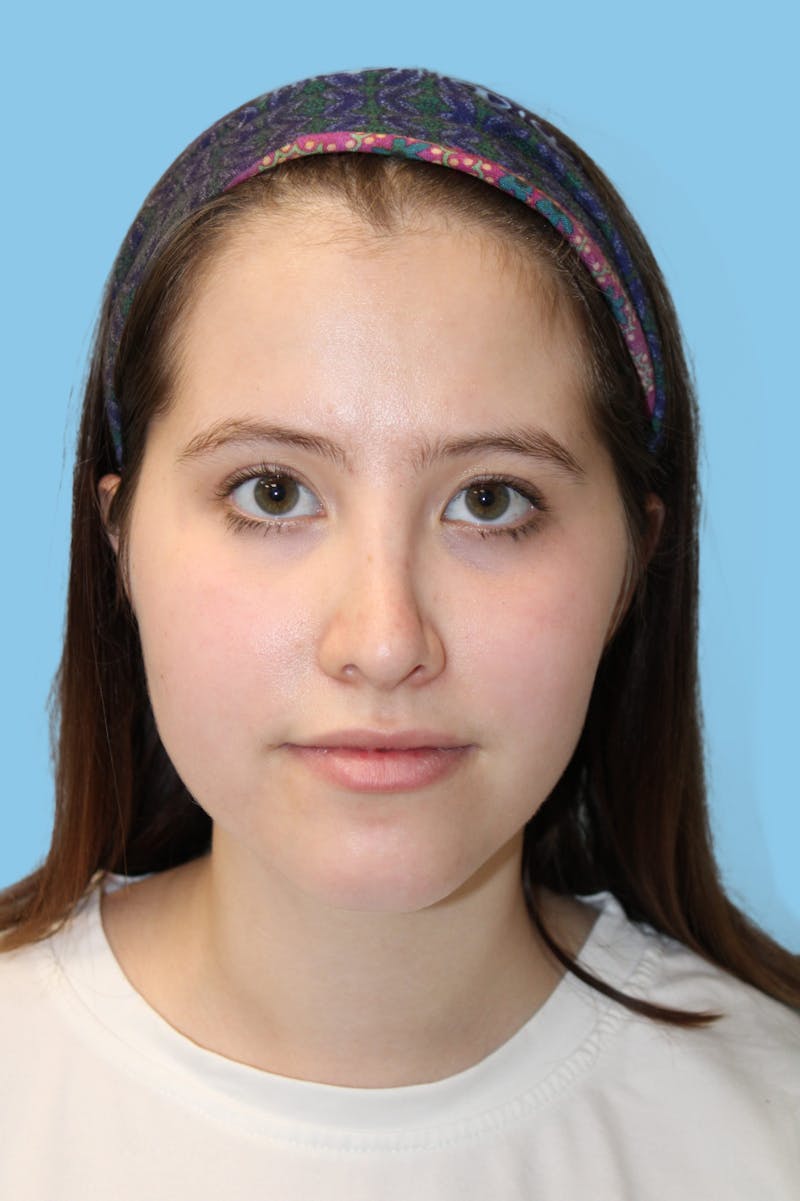 Rhinoplasty Before & After Gallery - Patient 289365 - Image 2