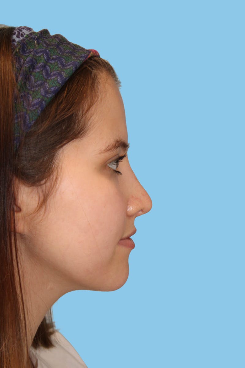 Rhinoplasty Before & After Gallery - Patient 289365 - Image 4