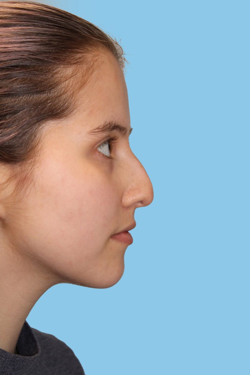 Rhinoplasty Before & After Gallery - Patient 289365 - Image 3