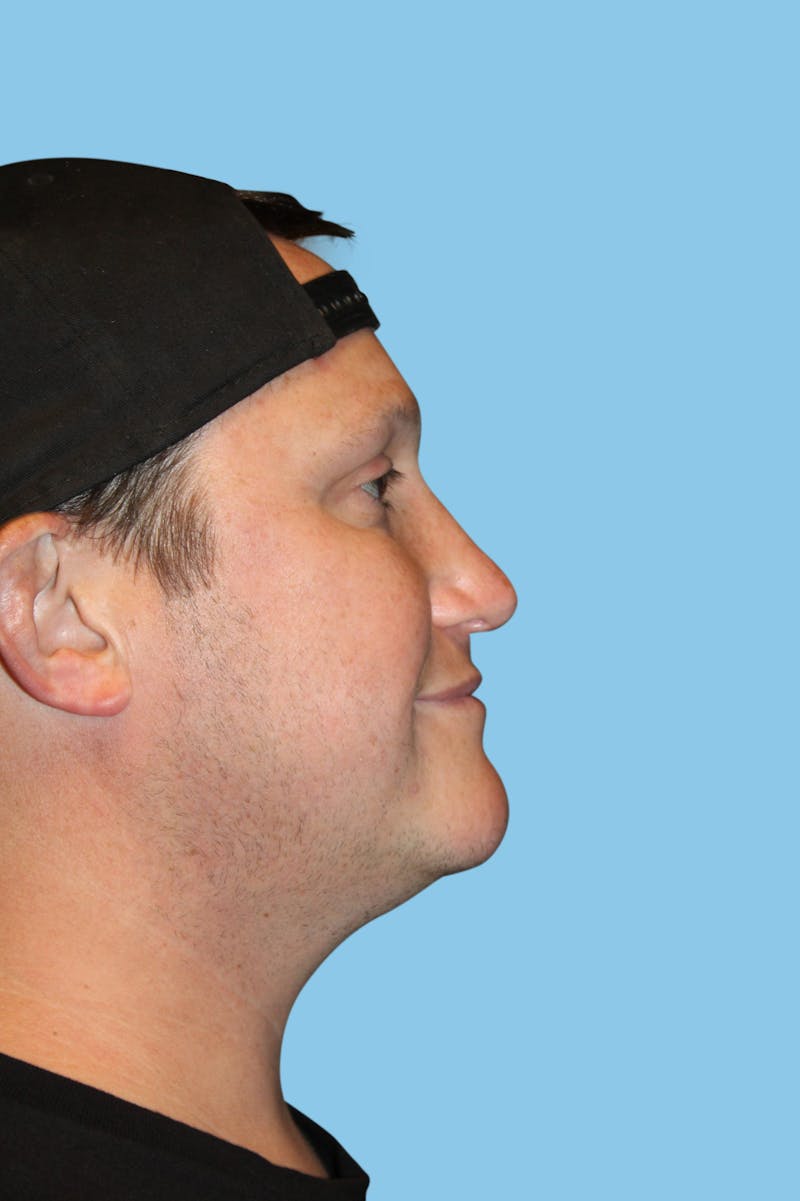 Rhinoplasty Before & After Gallery - Patient 385622 - Image 4