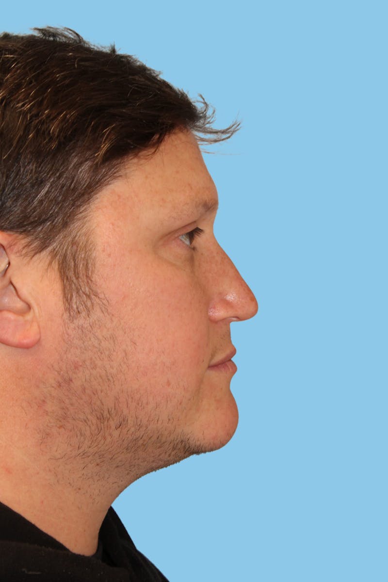 Rhinoplasty Before & After Gallery - Patient 385622 - Image 3