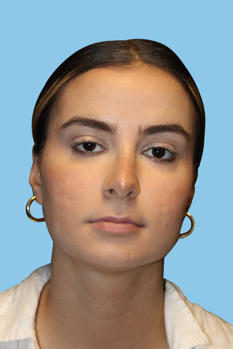 Rhinoplasty Before & After Gallery - Patient 279450 - Image 2