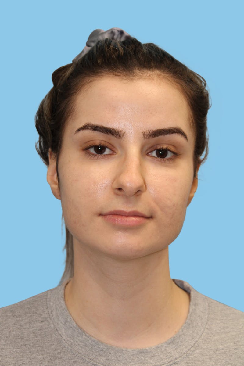 Rhinoplasty Before & After Gallery - Patient 279450 - Image 1