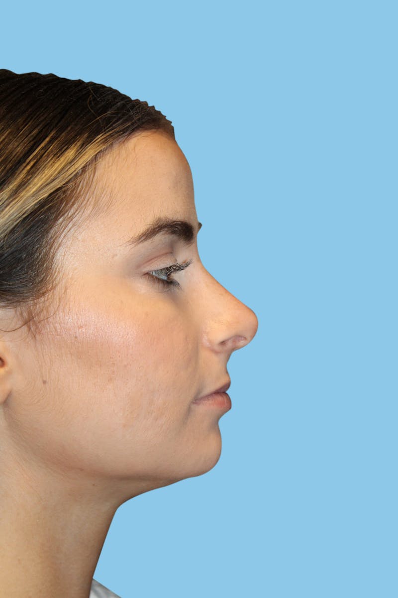 Rhinoplasty Before & After Gallery - Patient 279450 - Image 4