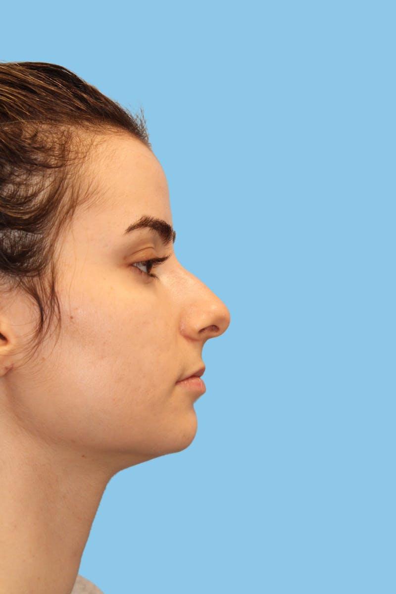 Rhinoplasty Before & After Gallery - Patient 279450 - Image 3